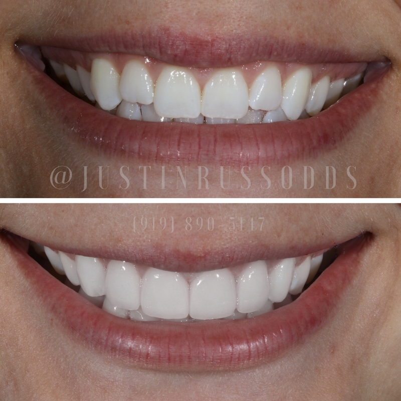 cosmetic dentistry veneers teeth dental implants whitening porcelain crowns raleigh bonding fillings fixed veneer nc bridges contouring makeover mercury smile