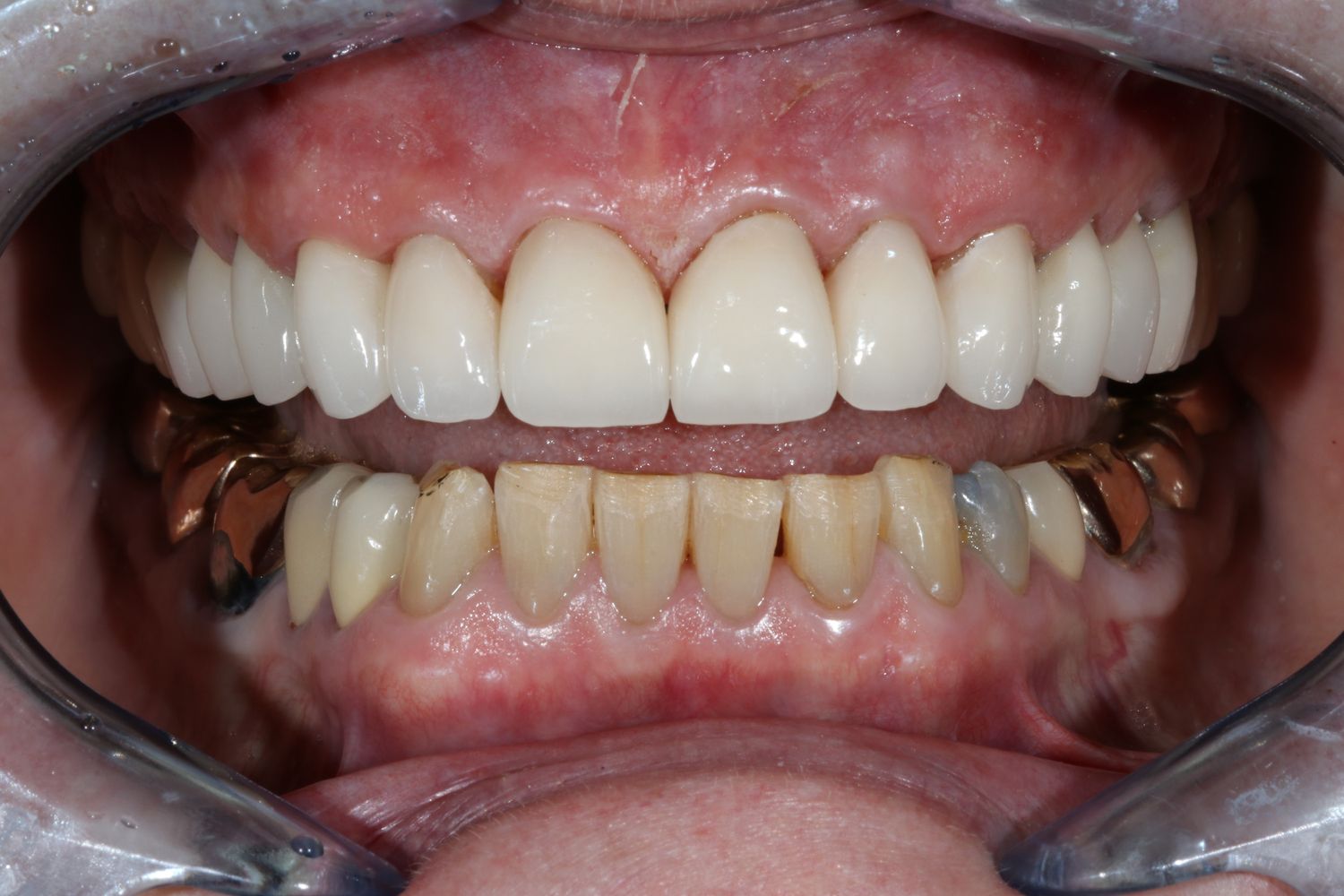 After Anti Aging Dentistry
