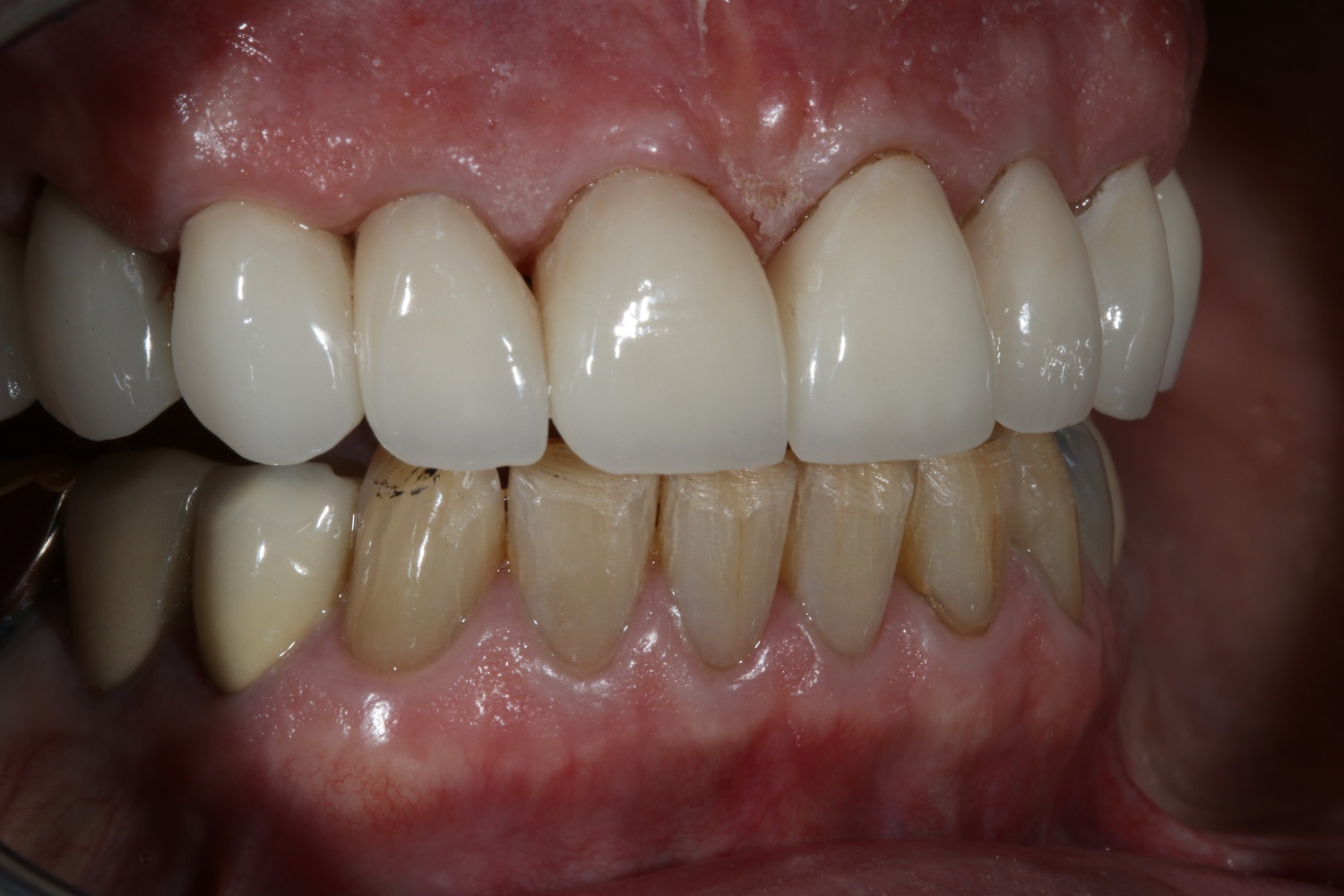 After Anti-Aging Dental Work