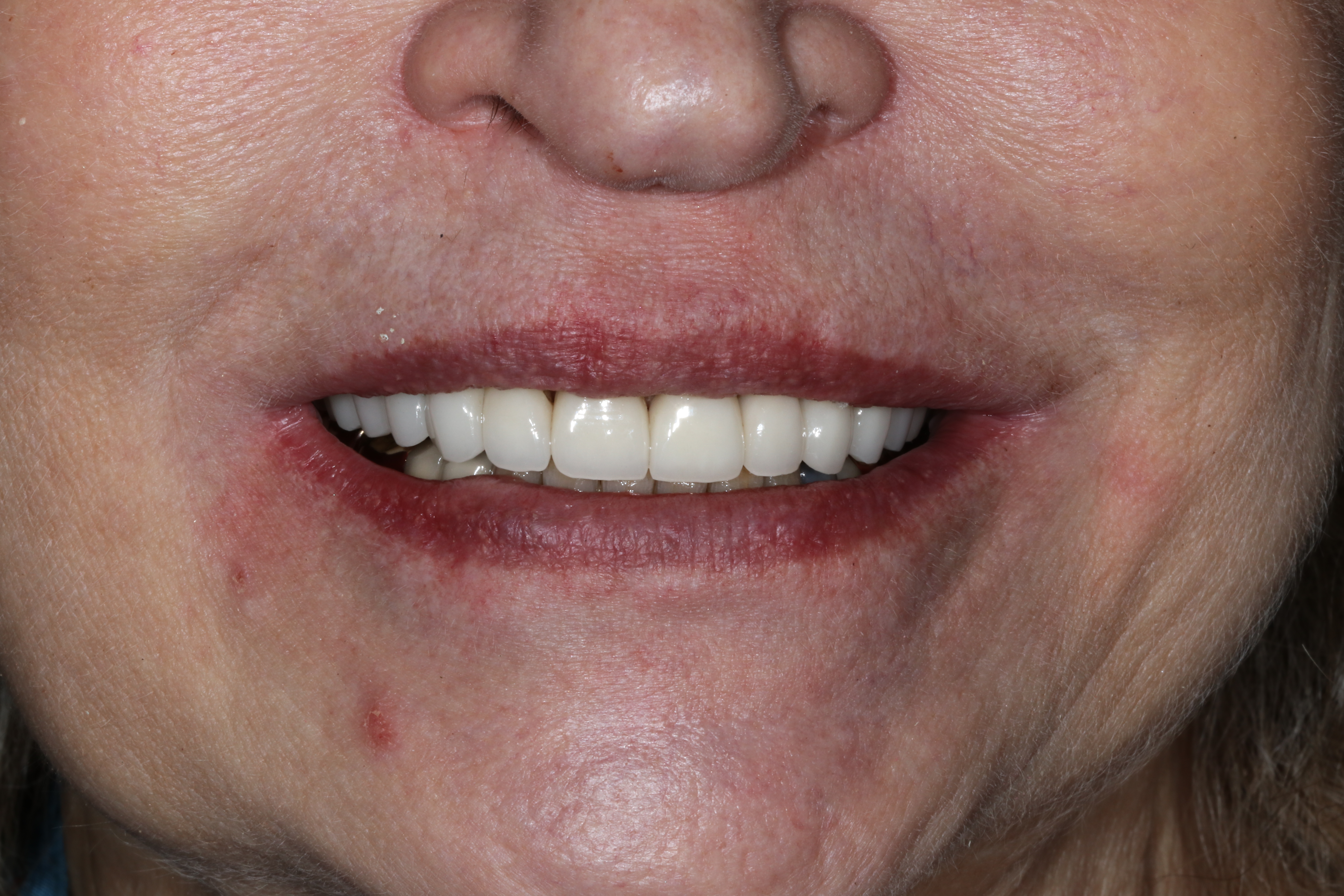 After Anti-Aging Dentistry From Russo DDS Raleigh