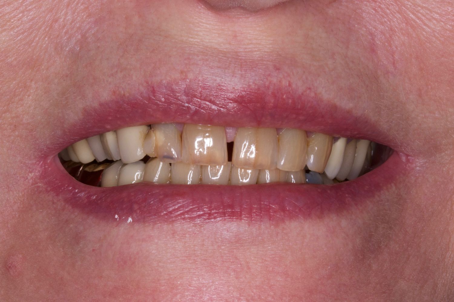 Before Anti-Aging Dentistry