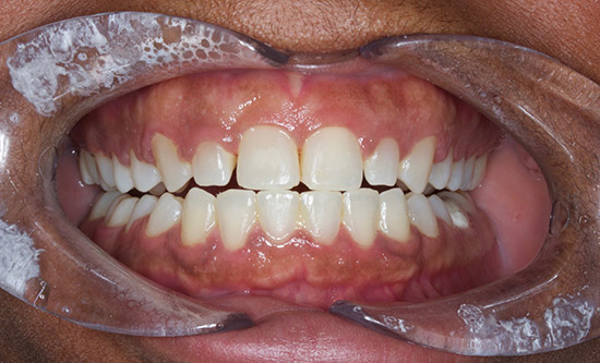 Before Gum Recontouring