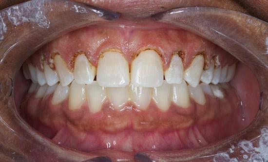 During Gum Recontouring