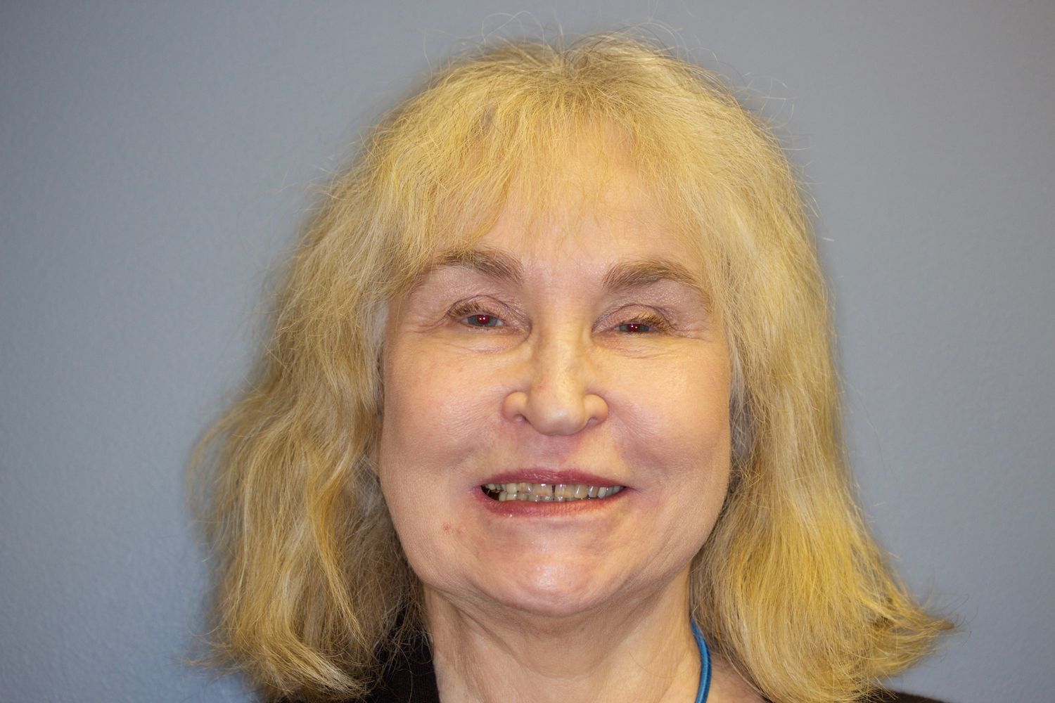 Before Anti-Aging Dentistry