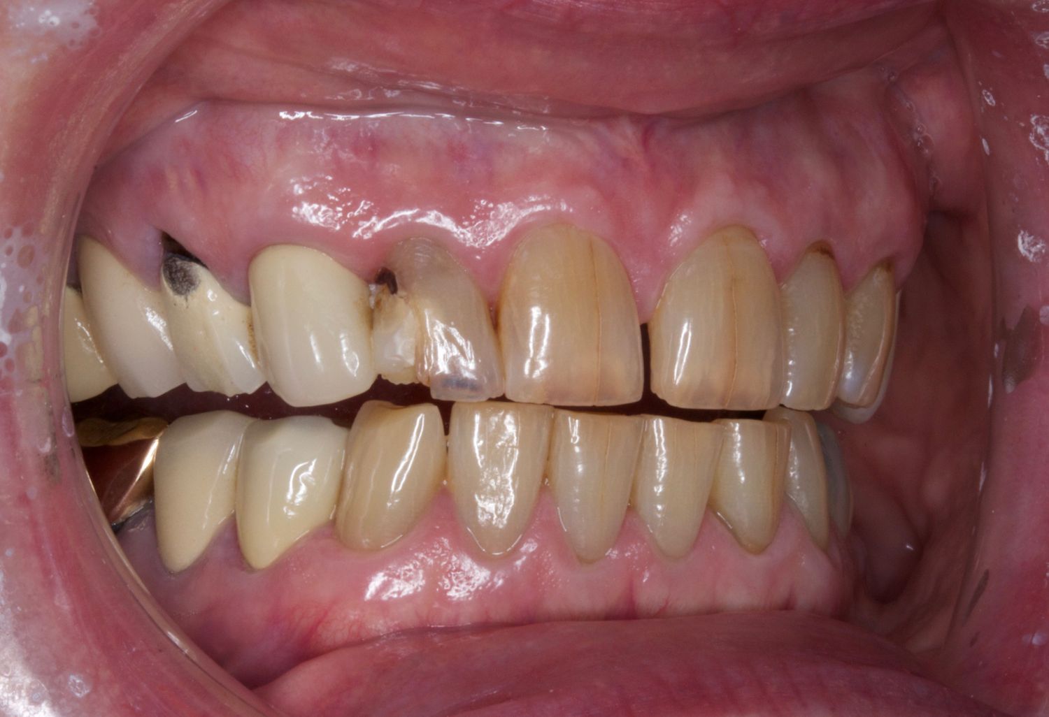 Before Anti Aging Dentistry