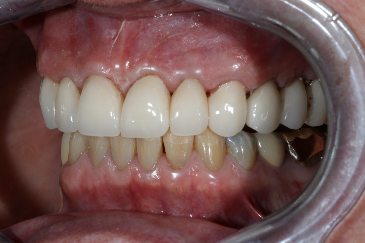 After Anti-Aging Dental Care