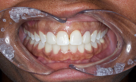 After Gum Recontouring