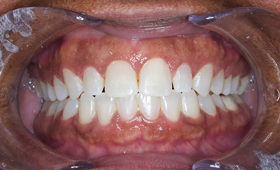 Healing After Gum Recontouring