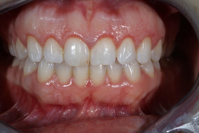 After Gum Recontouring