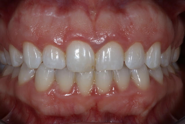 Before Gum Recontouring