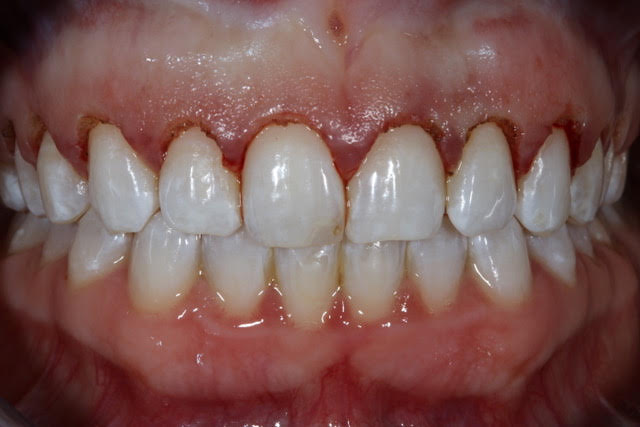 During Gum Recontouring