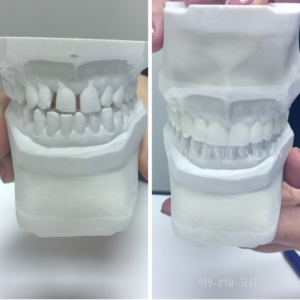 dentist tooth mold