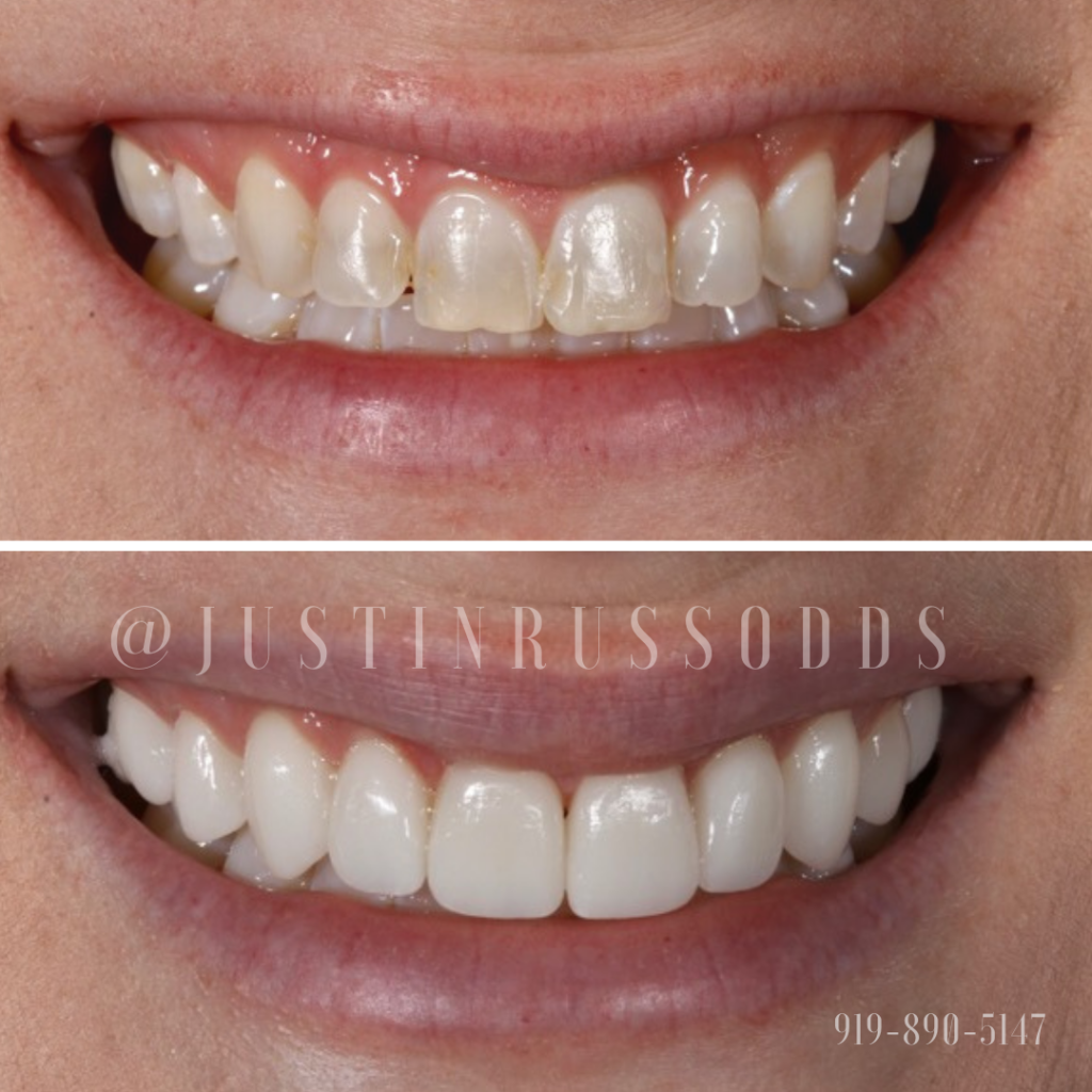 Before And After Smile Gallery | Russo Dentistry | Raleigh NC