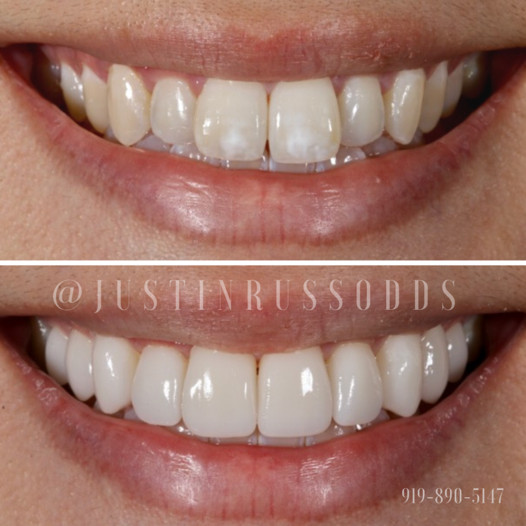 Before And After Smile Gallery | Russo Dentistry | Raleigh NC