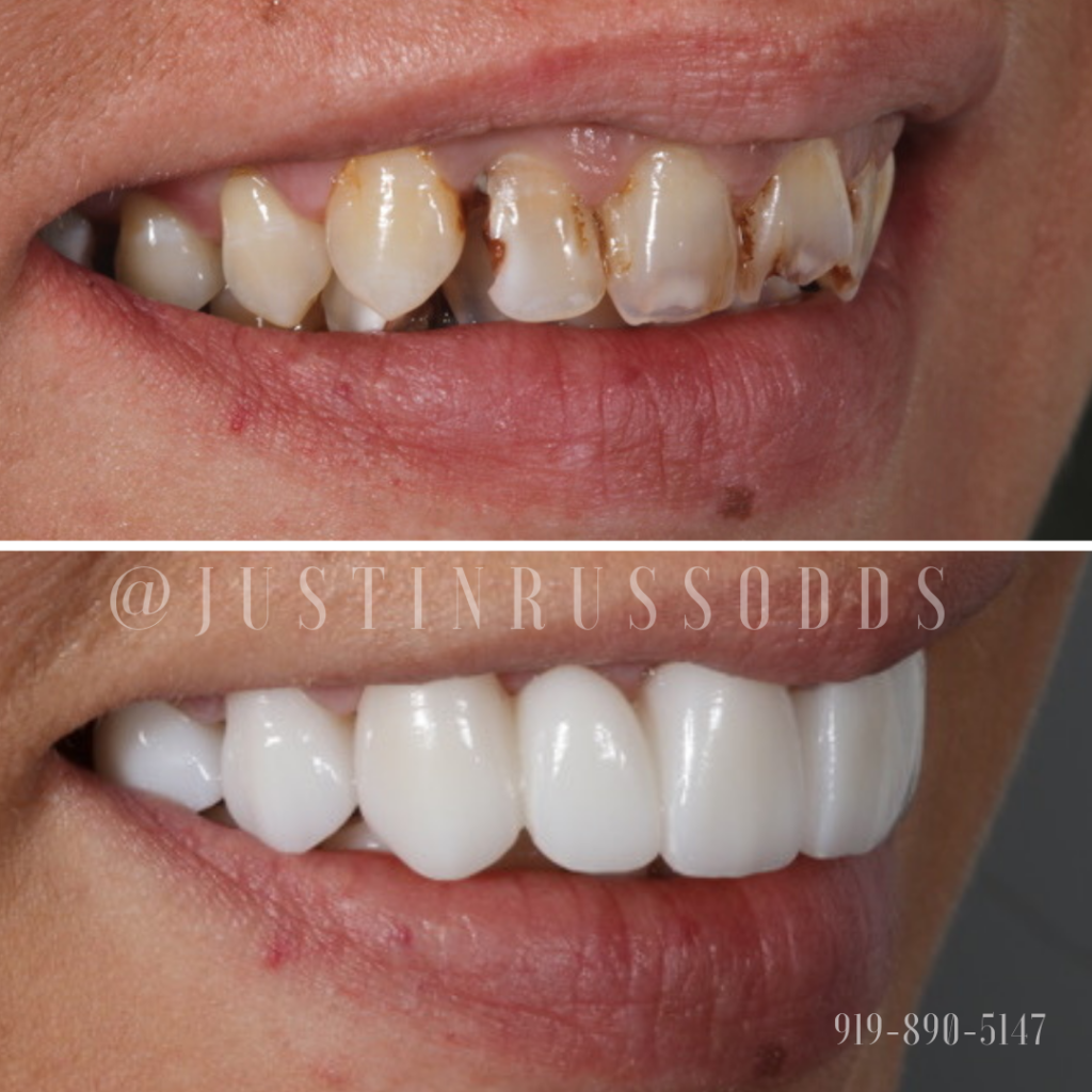 Before And After Smile Gallery | Russo Dentistry | Raleigh NC