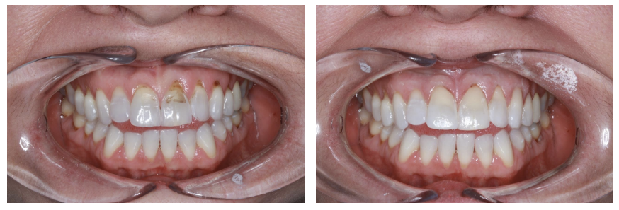 Resin Bonding to close spaces between lower front teeth and repair chipped  upper front tooth - Carroll Dental Care