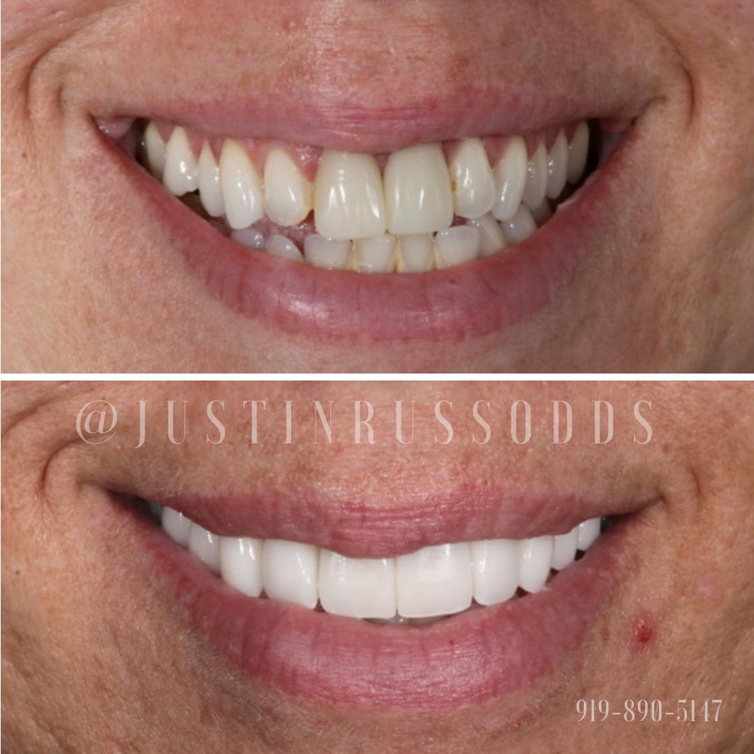 Before and After Smiles | Russo