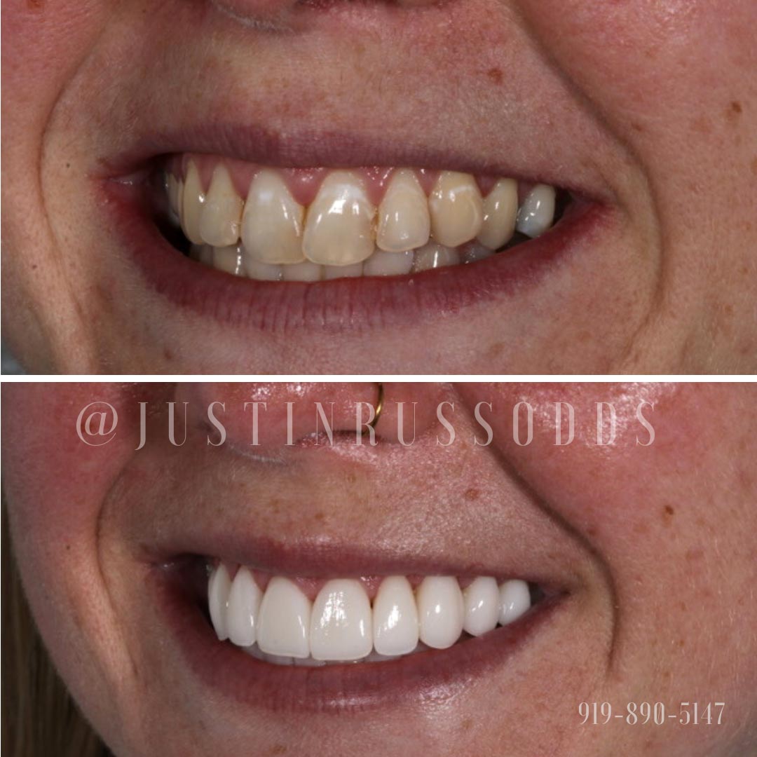 Before and After Smiles | Russo