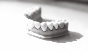 Russo dentistry bridges teeth composite bonding for high quality and trusted cosmetic results in Raleigh