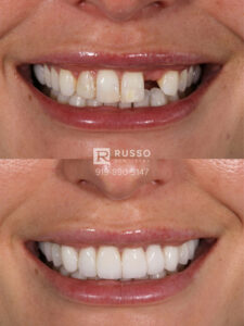 before after veneer smile case russo raleigh dds cosmetic dentist