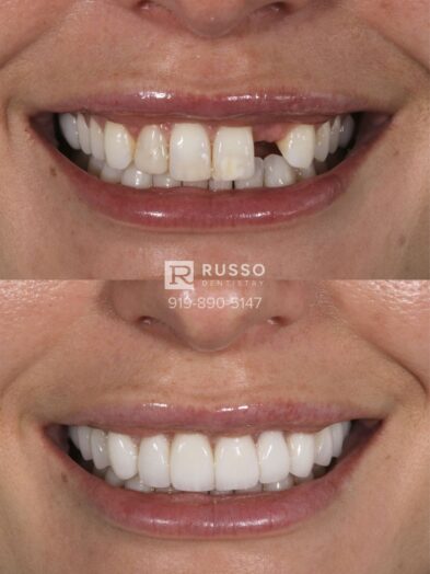 Smile Cases Russo DDS Before After White Teeth Veneers Implants Before After Cosmetic Dentistry
