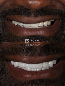 veneers smile design before after