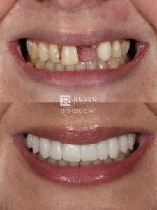 veneers smile design before after