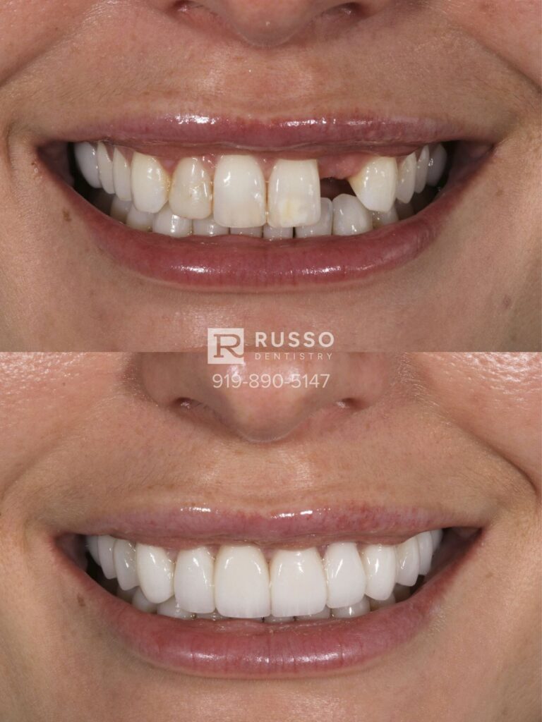 veneers smile design before after