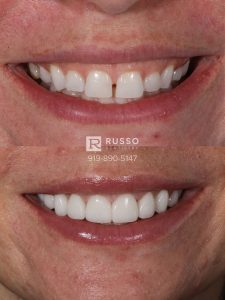 veneers smile design before after